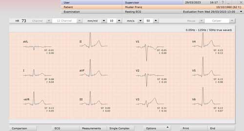 custo diagnostic — suivi segment ST tendance 12 canaux
