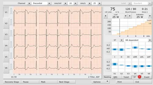 custo diagnostic — ECG d'effort vue complète 12 dérivations