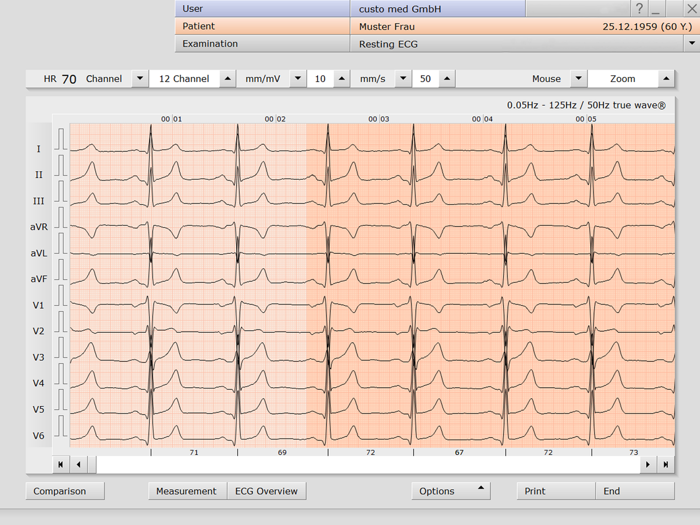 Comparatif filtre IIR vs true wave® custo med — signal ECG préservé